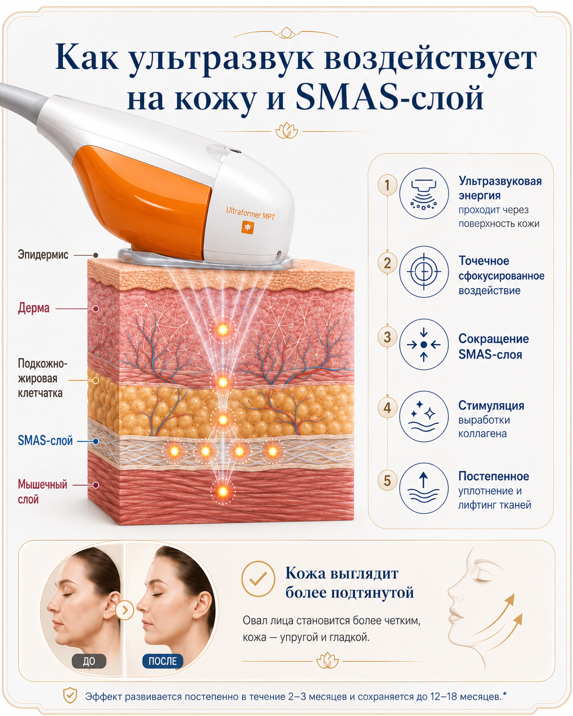 Инфографика, показывающая, как ультразвуковой импульс проходит через кожу и воздействует на SMAS-слой при SMAS-лифтинге